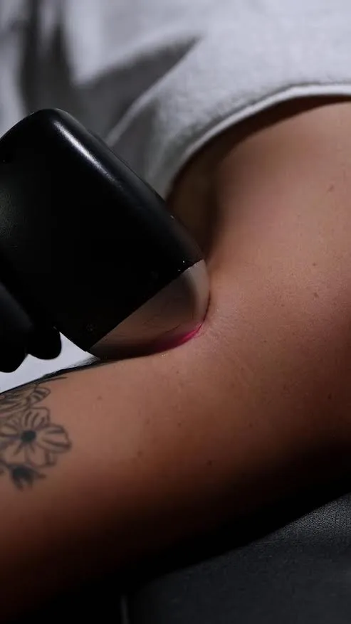 laser hair removal