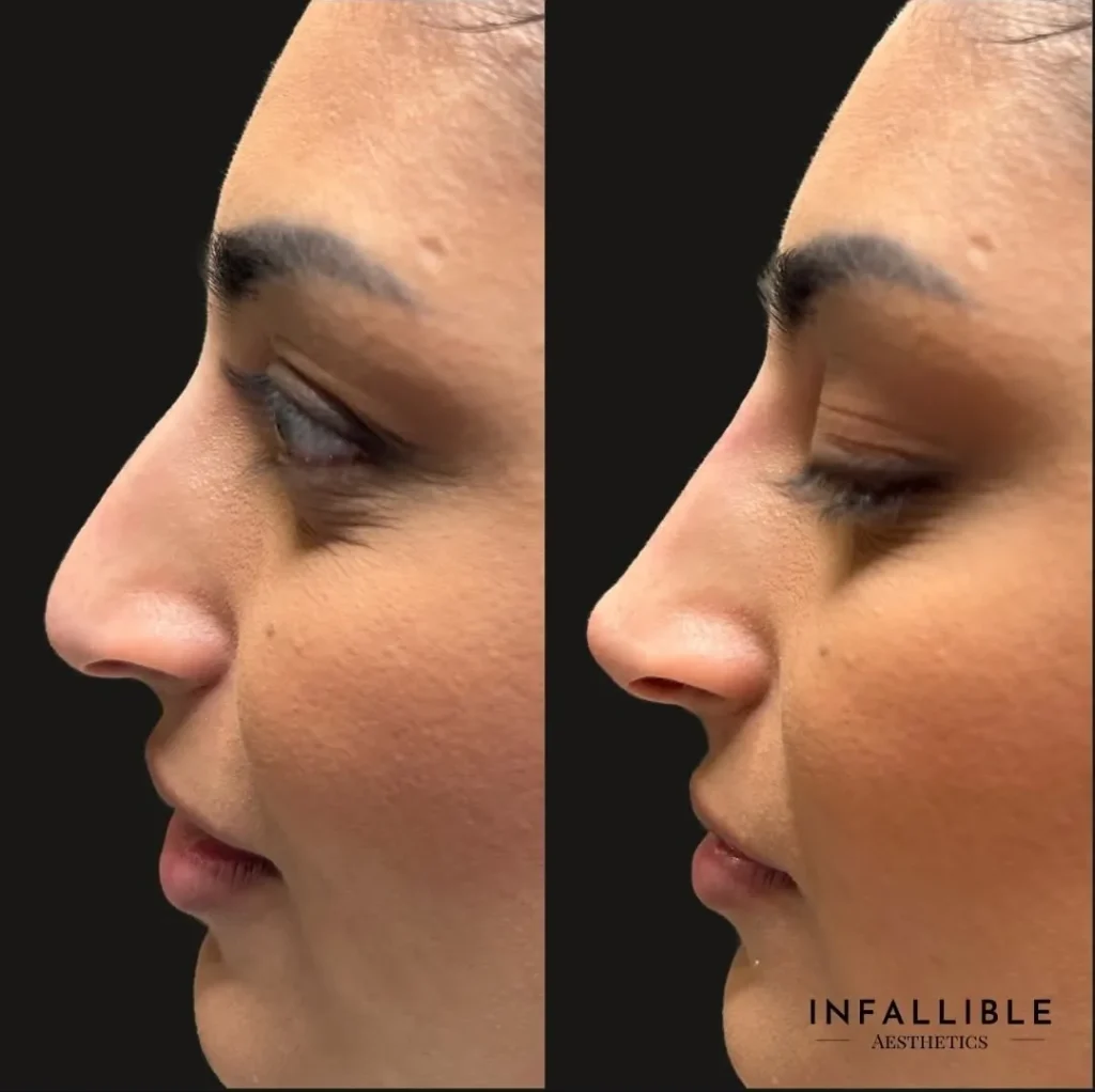 rhinoplasty